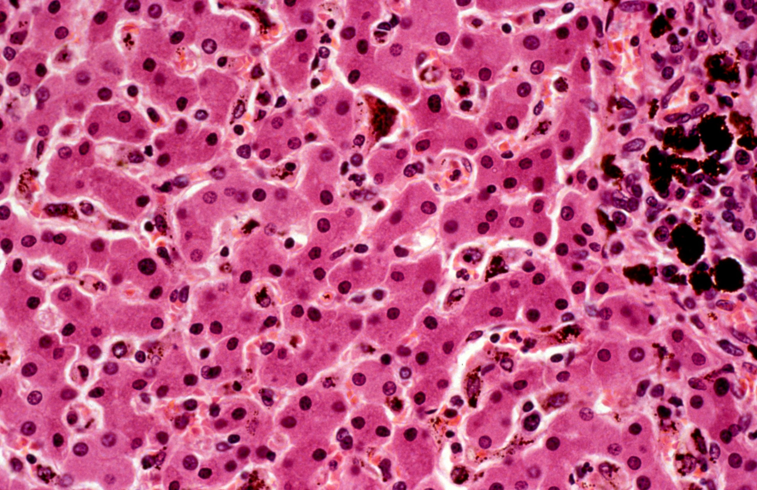 Plasmodium falciparum malaria: liver. Wellcome Collection. CC0 1.0 Universal, malaria case studies